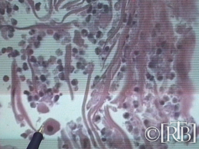 tabel Forensisch patholoog dr. Robert Lawrence in San Francisco die het identificeerde als een epidermis (huid) geïnfiltreerd met witte bloedcellen.