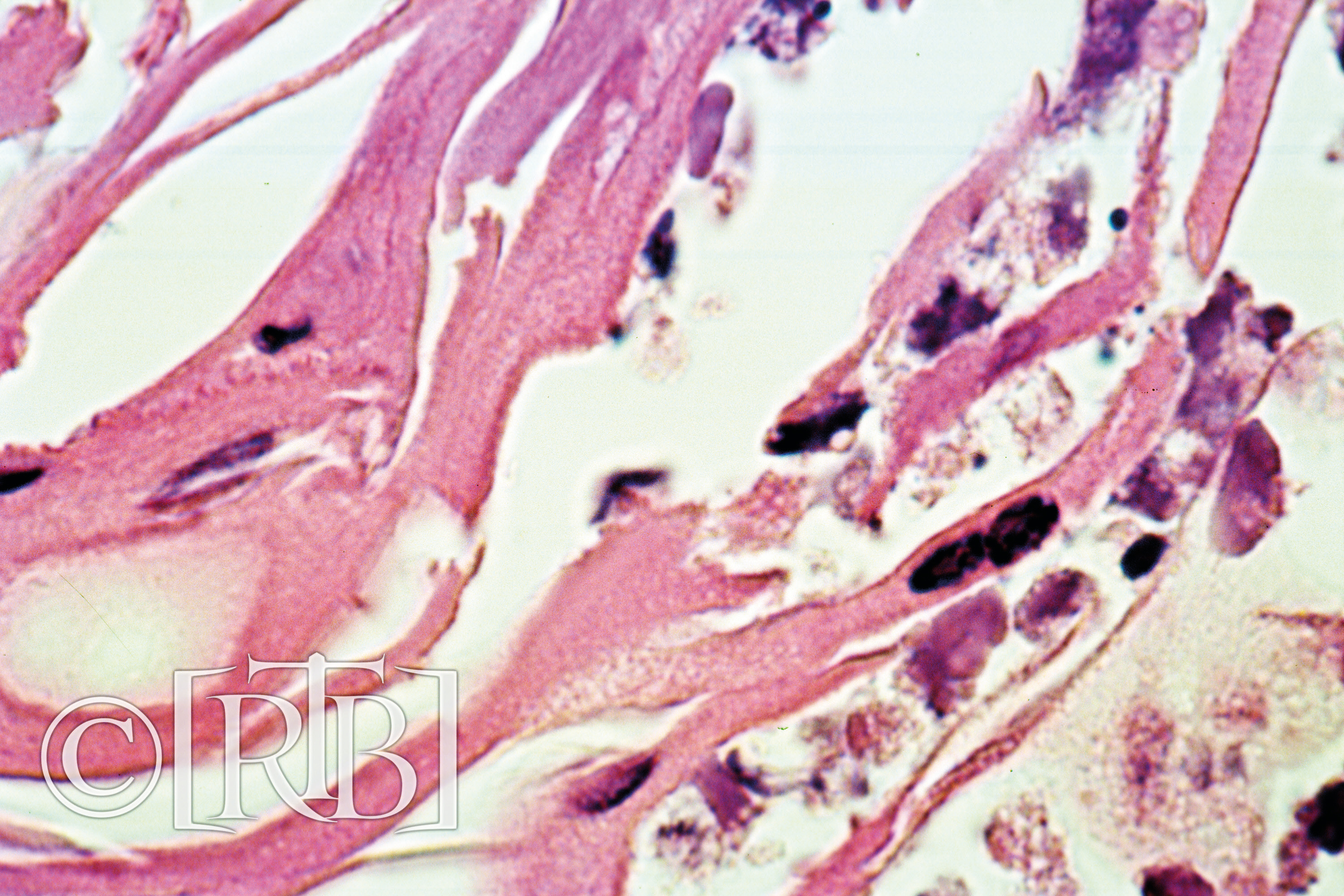 Microscopisch histologisch objectglaasje waarop ontstoken menselijk myocardweefsel (hartspier) met actieve witte bloedcellen te zien is